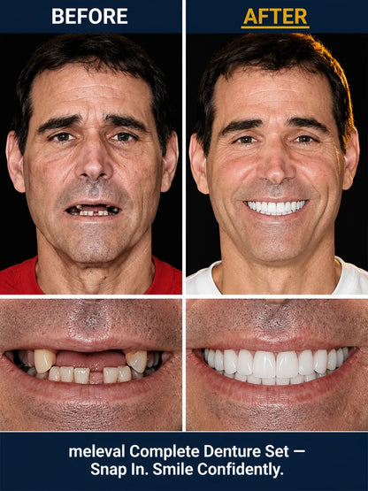 Premium Complete Denture Set
