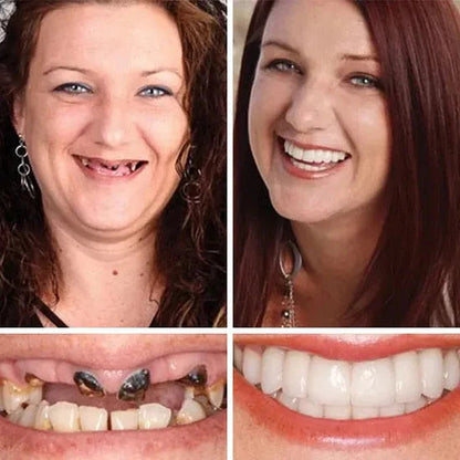 ⏰Ends Today: 70% OFF! 🌎Demany™ Medical Full Denture with Strong Suctiond🦷Obtain American Dental Association (ADA) Certification