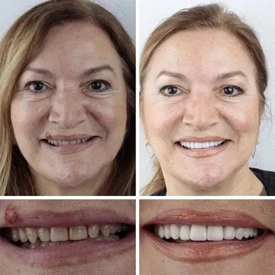 ⏰Ends Today: 70% OFF! 🌎Demany™ Medical Full Denture with Strong Suctiond🦷Obtain American Dental Association (ADA) Certification